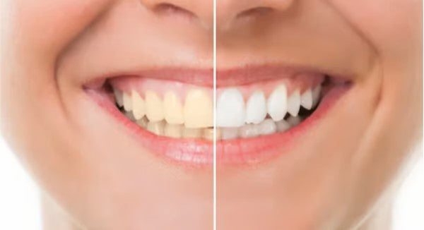 SmilePure Pro™ | Jouw witte glimlach begint hier | 1+2 gratis