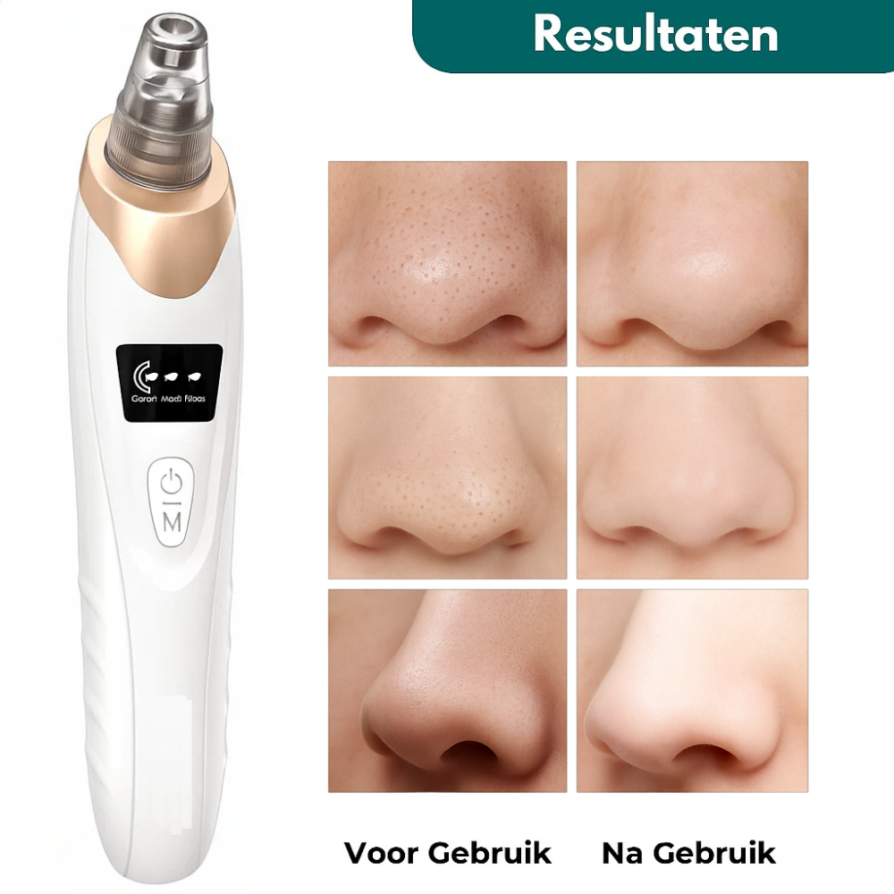 PureSkin Pro™ – Vacuüm Mee-eter Verwijderaar voor een Frissere Huid
