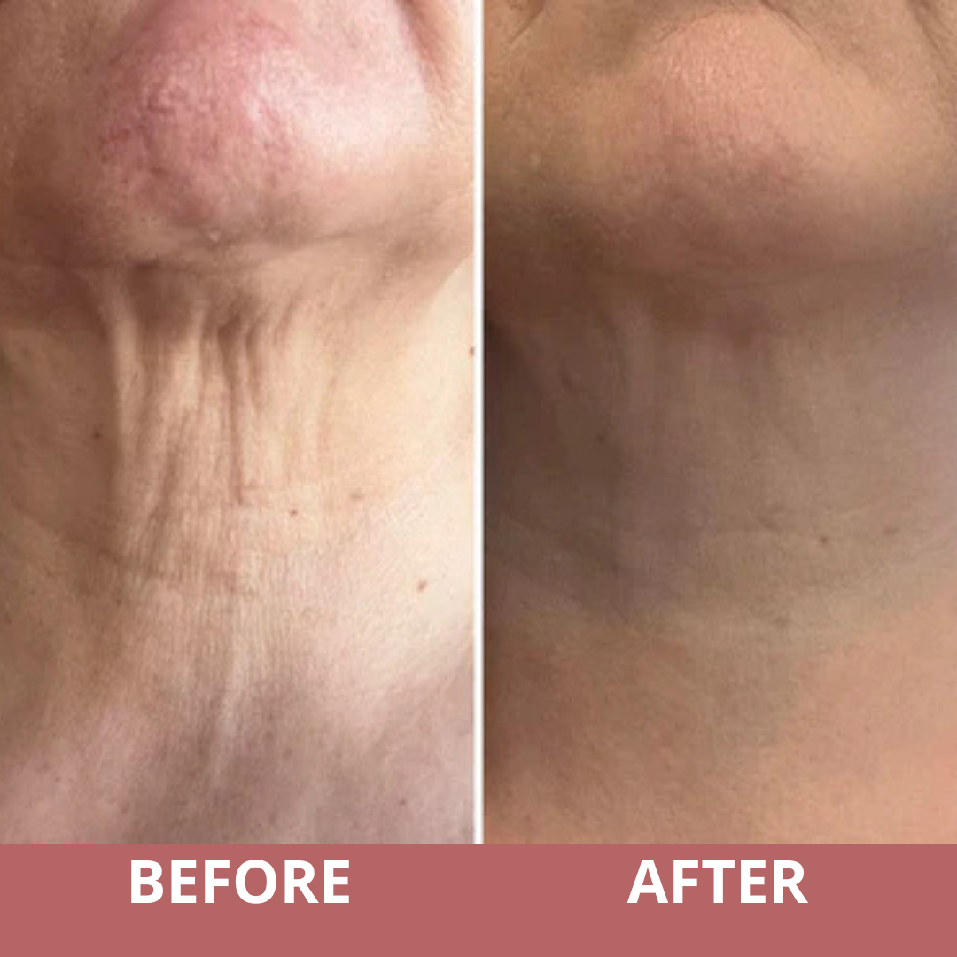 NeckLuxe™ – Lift & Verstevigende Crème voor Hals en Decolleté
