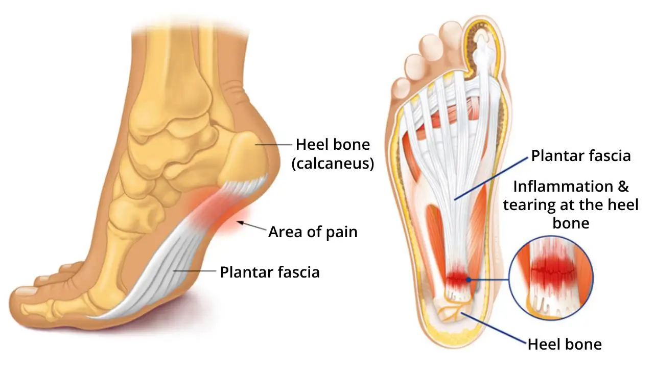 SoleEase™ – De Ergonomische Inlegzool