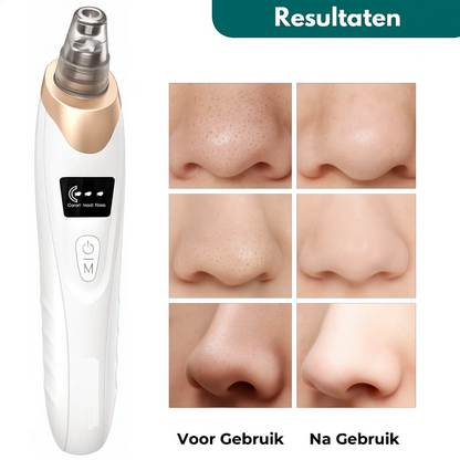 PureSkin Pro™ – Vacuüm Mee-eter Verwijderaar voor een Frissere Huid