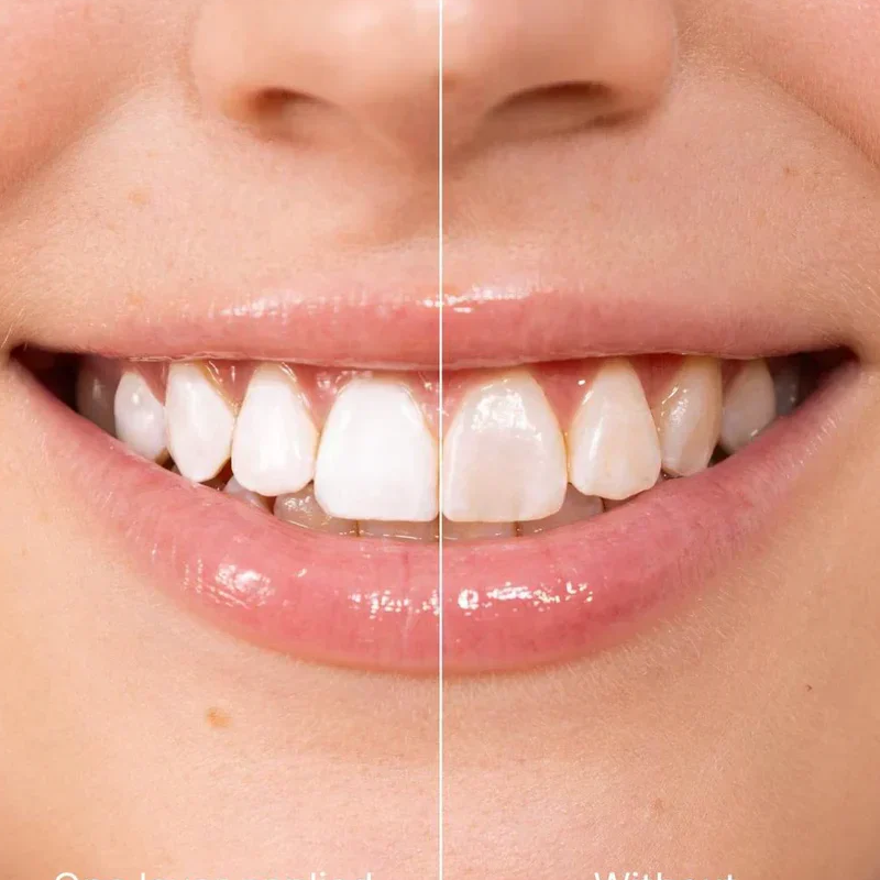 Smilevia™ - BrightTouch – Directe Tandglans Gel | 1+1 GRATIS