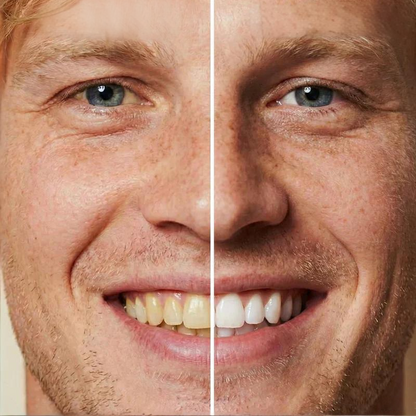 Smilevia™ - BrightTouch – Directe Tandglans Gel | 1+1 GRATIS